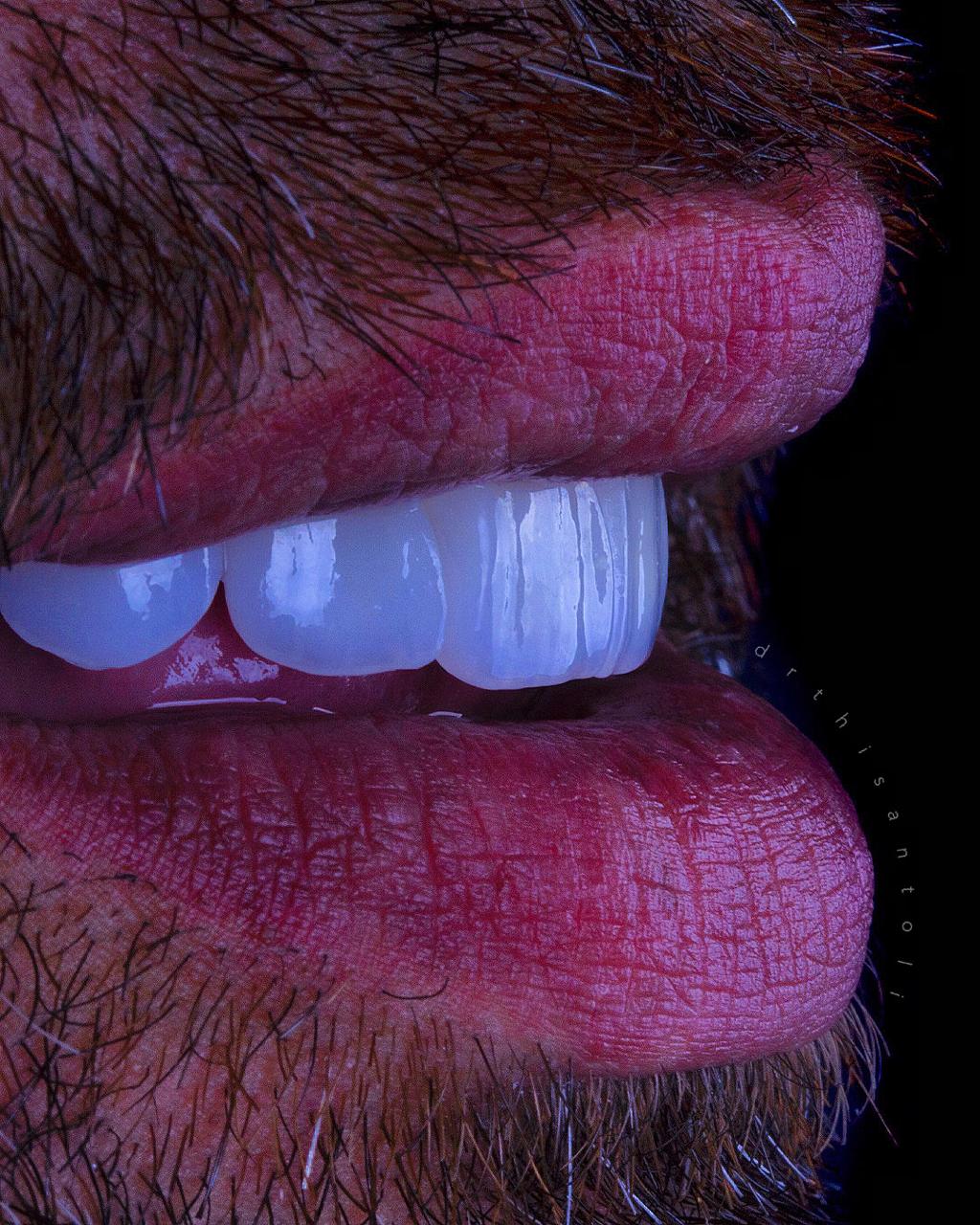 Implante Dentário
